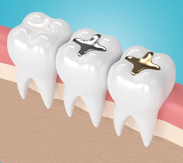 Portsmouth Composite Fillings