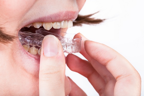 How To Prepare For Your Consultation With An Invisalign Dentist